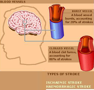 the-stroke-facts